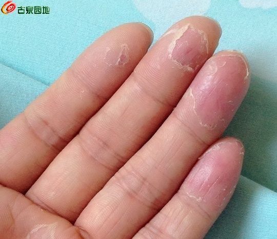 手脱皮好了 每年春天 秋天最严重 去年冬天用了